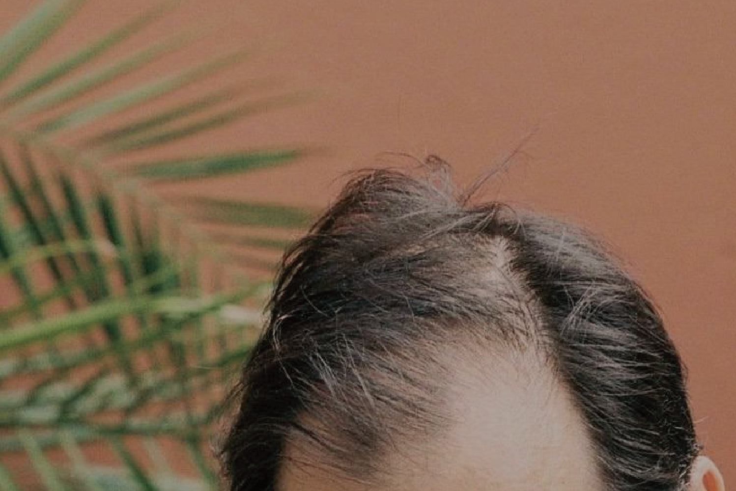 men, hair loss, blog, treat